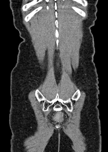 Adhesional small bowel obstruction (Radiopaedia 48397-53305 Coronal C+ portal venous phase 320).jpg