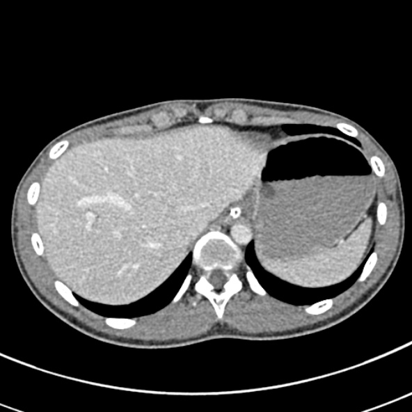 Adhesional small bowel obstruction (Radiopaedia 52107-57980 Axial C+ portal venous phase 16).jpg