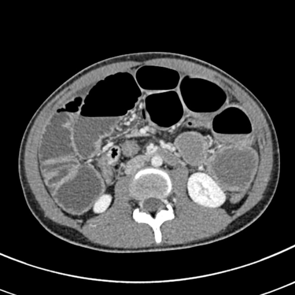 File:Adhesional small bowel obstruction (Radiopaedia 52107-57980 Axial C+ portal venous phase 56).jpg