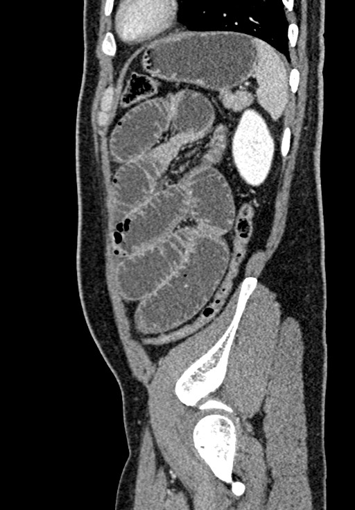 Adhesional small bowel obstruction (Radiopaedia 58900-66131 Sagittal C+ portal venous phase 201).jpg