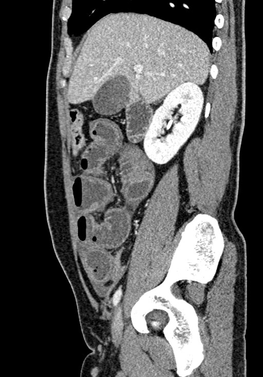 Adhesional small bowel obstruction (Radiopaedia 58900-66131 Sagittal C+ portal venous phase 78).jpg