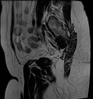 File:Adnexal multilocular cyst (O-RADS US 3- O-RADS MRI 3) (Radiopaedia 87426-103754 Sagittal T2 4).jpg