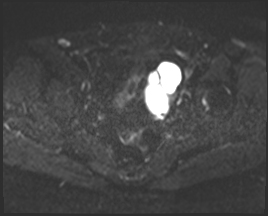 File:Adnexal multilocular cyst (O-RADS US 3. O-RADS MRI 3) (Radiopaedia 87426-103754 Axial 137).jpeg