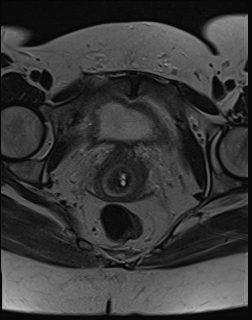File:Adnexal multilocular cyst (O-RADS US 3. O-RADS MRI 3) (Radiopaedia 87426-103754 Axial 19).jpeg