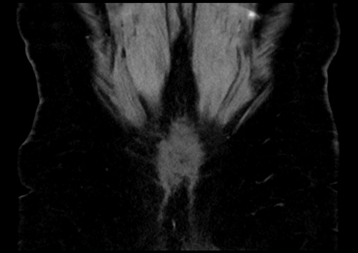 Adrenal cortical carcinoma (Radiopaedia 64017-72769 Coronal C+ portal venous phase 52).jpg
