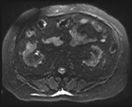 File:Adrenal cortical carcinoma (Radiopaedia 64017-72770 Axial DWI 68).jpg