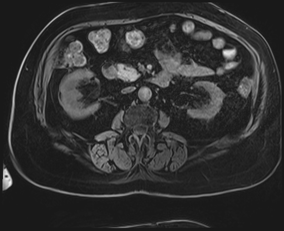 Adrenal cortical carcinoma (Radiopaedia 64017-72770 Axial T1 C+ fat sat 28).jpg
