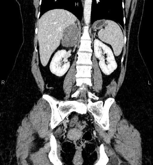 Adrenal cortical carcinoma (Radiopaedia 84882-100379 Coronal C+ portal venous phase 43).jpg