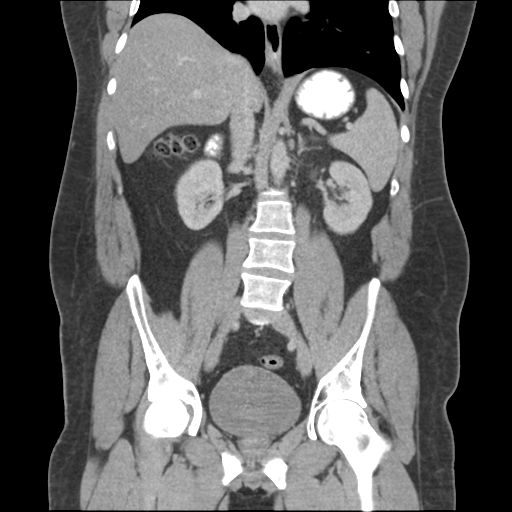 Adrenal cyst (Radiopaedia 45625-49776 Coronal C+ portal venous phase 43).png