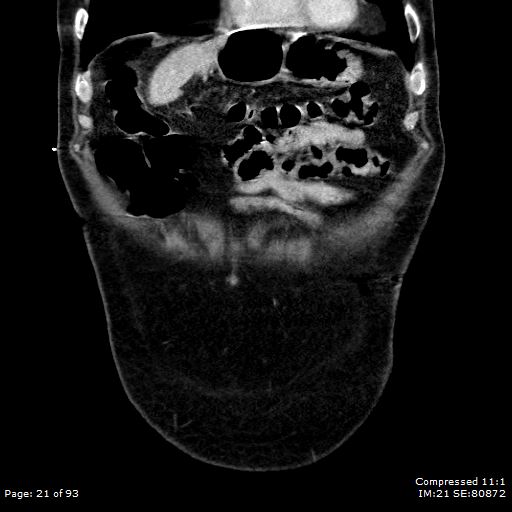 Adrenal metastasis (Radiopaedia 78425-91079 Sagittal C+ portal venous phase 8).jpg