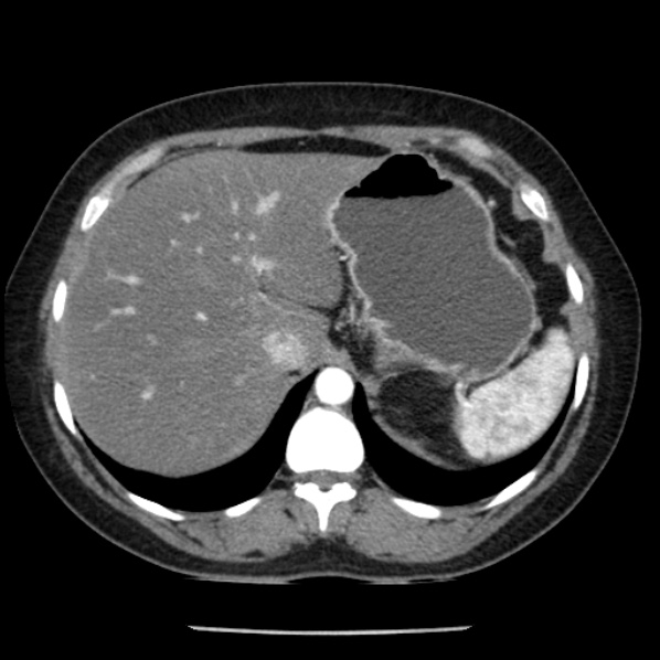 Adrenal myelolipoma (Radiopaedia 43401-46759 Axial C+ arterial phase 19).jpg