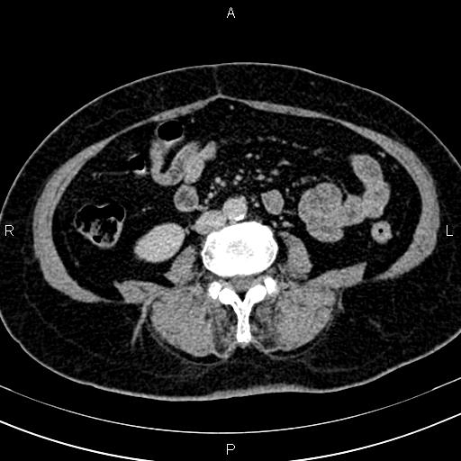 Adrenal myelolipoma (Radiopaedia 82742-96986 Axial renal excretory phase 90).jpg