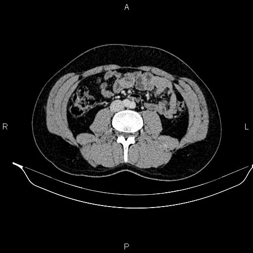 Adrenal myelolipoma (Radiopaedia 87794-104246 Axial renal cortical phase 59).jpg