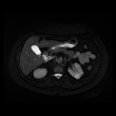 File:Adrenal myelolipoma - MRI (Radiopaedia 83249-97646 Axial STIR 17).jpg