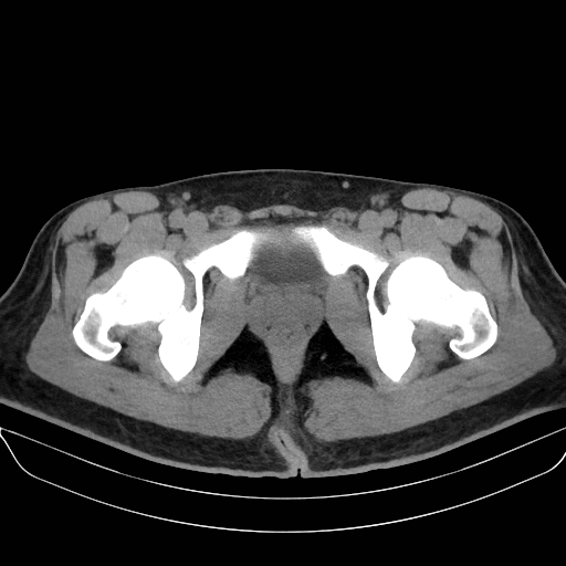 Adrenal myelolipoma - bilateral (Radiopaedia 74805-85810 Axial non-contrast 83).jpg