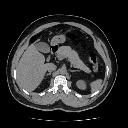 Adrenal myelolipoma and beaver tail liver (Radiopaedia 86201-102193 Axial non-contrast 149).jpg