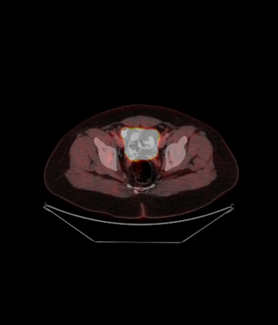 Adrenocortical carcinoma (Radiopaedia 80134-93440 ِAxial 241).jpg
