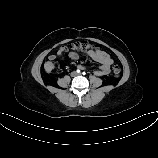 Adrenocortical carcinoma (Radiopaedia 87281-103569 Axial C+ arterial phase 54).jpg