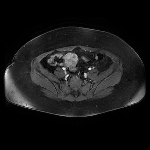File:Adult granulosa cell tumor of the ovary (Radiopaedia 64991-73953 axial-T1 Fat sat post-contrast dynamic 51).jpg