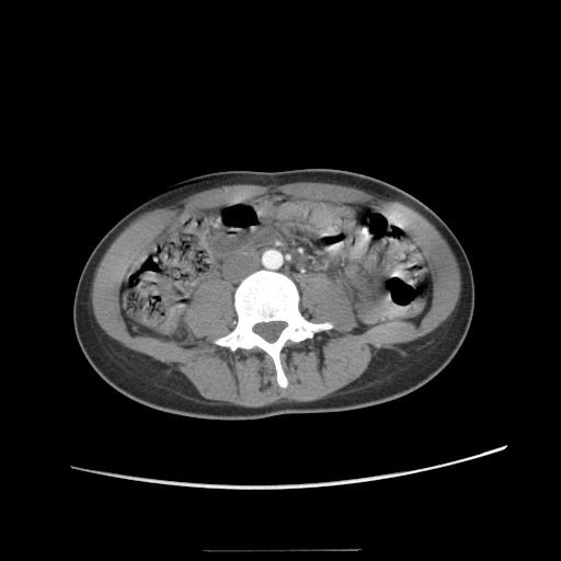 Adult polycystic kidney disease (Radiopaedia 48845-53876 Axial renal cortical phase 41).jpg