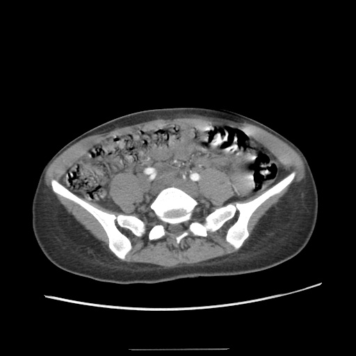 Adult polycystic kidney disease (Radiopaedia 48845-53876 Axial renal cortical phase 53).jpg