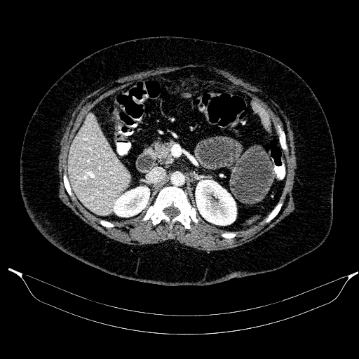 Afferent loop syndrome - secondary to incarcerated trocar site hernia (Radiopaedia 82959-97305 Axial C+ portal venous phase 83).jpg