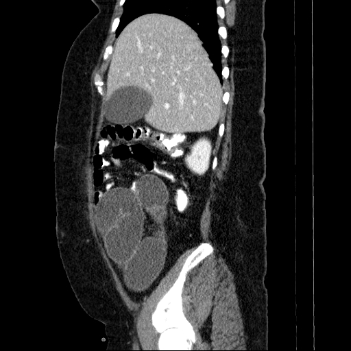 File:Afferent loop syndrome - secondary to incarcerated trocar site hernia (Radiopaedia 82959-97305 Sagittal C+ portal venous phase 119).jpg