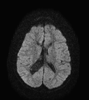 File:Aicardi syndrome (Radiopaedia 66029-75205 Axial DWI 14).jpg