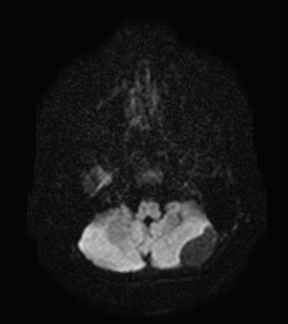 File:Aicardi syndrome (Radiopaedia 66029-75205 Axial DWI 4).jpg