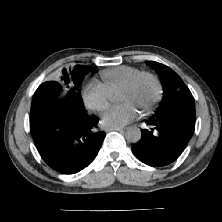 Airway foreign body in adult (Radiopaedia 85907-101779 Axial liver window 119).jpg