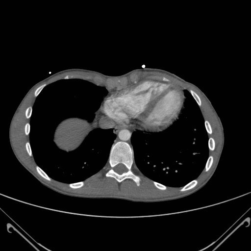File:Alagille syndrome with pulmonary hypertension (Radiopaedia 49384-54980 A 13).jpg