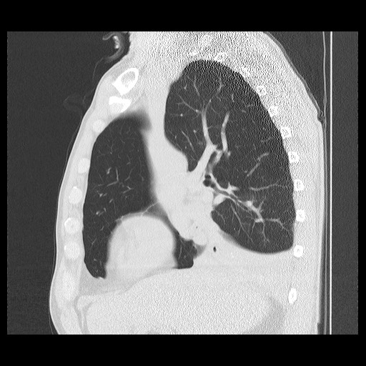 Allergic bronchopulmonary aspergillosis (ABPA) (Radiopaedia 60594-68313 Sagittal lung window 38).jpg