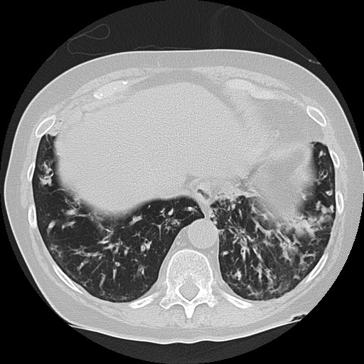 Alpha-1-antitrypsin deficiency (Radiopaedia 72058-82557 Axial lung window 59).jpg