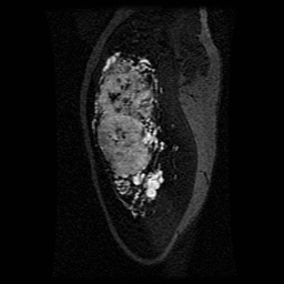 Alveolar soft part sarcoma (Radiopaedia 64501-73678 D 106).jpg