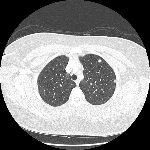 Alveolar soft part sarcoma - right leg (Radiopaedia 59432-67091 Axial lung window 28).jpg