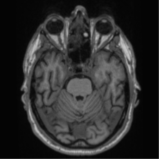 Alzheimer's disease- with Gerstmann syndrome and dressing apraxia (Radiopaedia 54882-61150 Axial T1 23).png