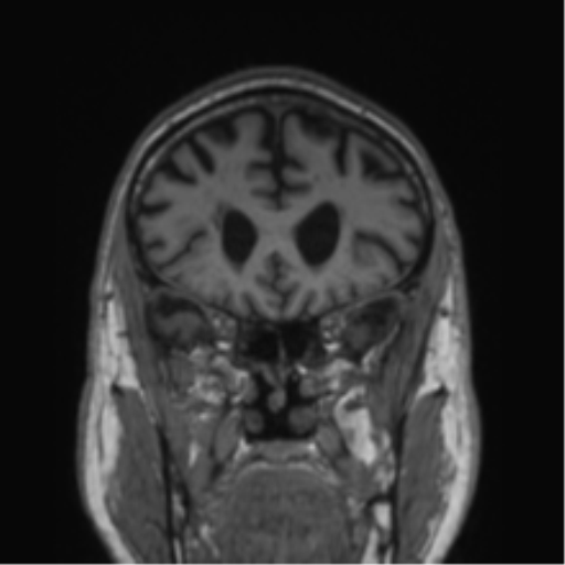 Alzheimer's disease- with Gerstmann syndrome and dressing apraxia (Radiopaedia 54882-61150 Coronal T1 66).png