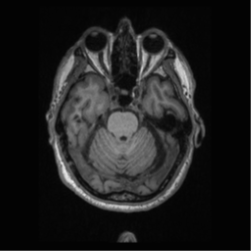 Alzheimer disease - probable (Radiopaedia 35334-36837 Axial T1 27).png