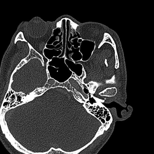 Ameloblastoma (Radiopaedia 51921-57766 Axial bone window 157).jpg