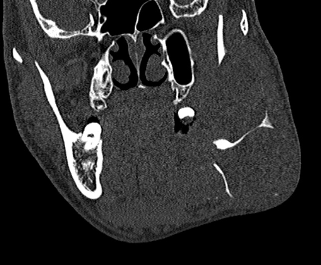Ameloblastoma (Radiopaedia 51921-57766 Coronal bone window 111).jpg