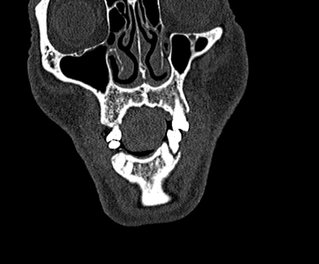 Ameloblastoma (Radiopaedia 51921-57766 Coronal bone window 37).jpg