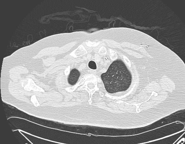 File:Amiodarone lung (Radiopaedia 62514-70769 Axial lung window 10).jpg