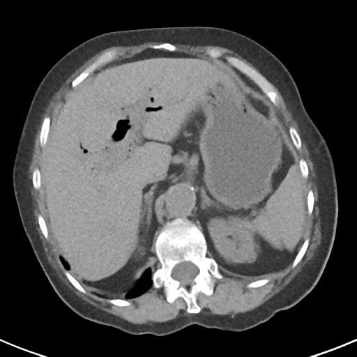 File:Ampullary adenocarcinoma (Radiopaedia 34013-35237 Axial non-contrast 12).png