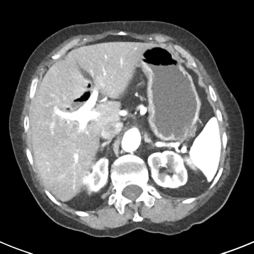 Ampullary adenocarcinoma (Radiopaedia 34013-35237 B 21).png