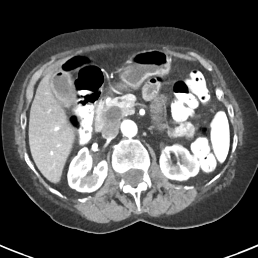 Ampullary adenocarcinoma (Radiopaedia 34013-35237 B 34).png