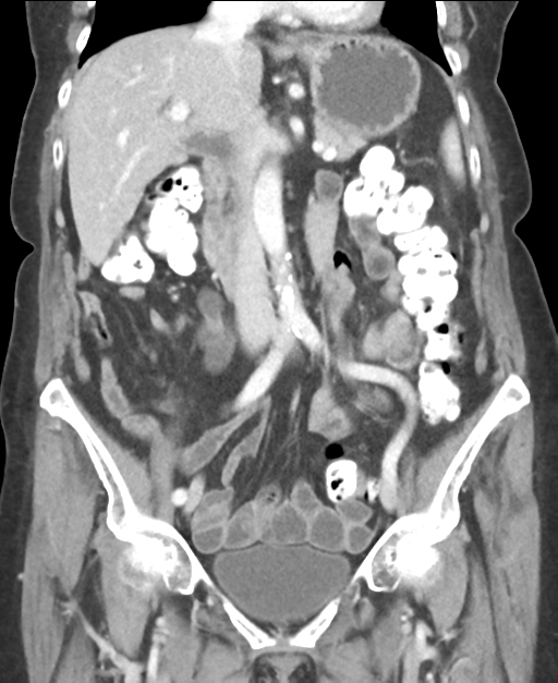 Ampullary adenocarcinoma (Radiopaedia 34013-35237 E 25).png
