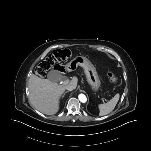 Ampullary adenocarcinoma (Radiopaedia 59373-66734 A 45).jpg