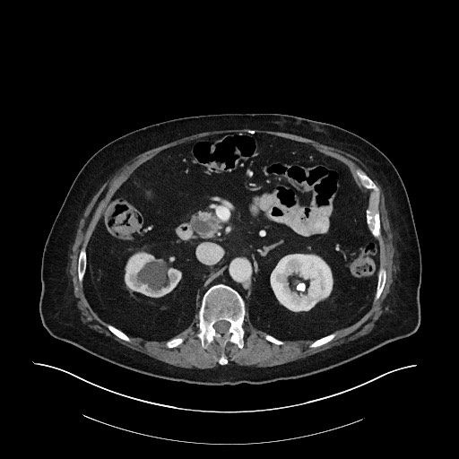 Ampullary adenocarcinoma (Radiopaedia 59373-66734 C 60).jpg