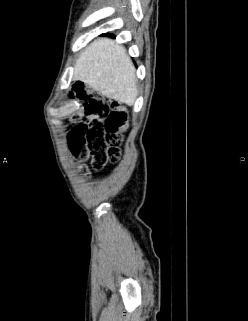 Ampullary adenocarcinoma (Radiopaedia 86093-102032 D 4).jpg