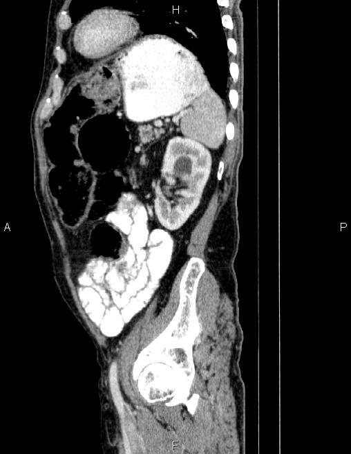Ampullary adenocarcinoma (Radiopaedia 86093-102032 D 74).jpg